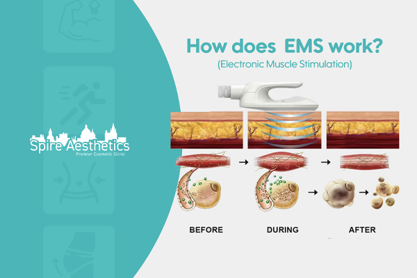 EMS treatment for post pregnancy weight loss treatment Moseley