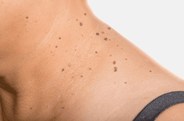 Are you looking for easy skin tag removal Moseley - then contact Spire today!