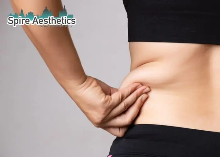 Image of woman pinching fat on their hips Moseley. Fat Freezing treatment