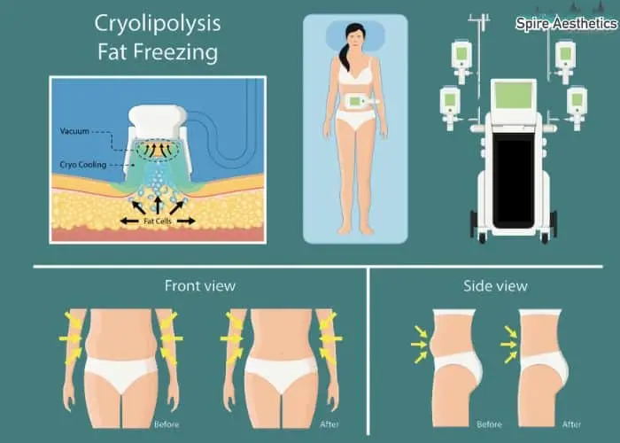 Fat freezing treatment Moseley benefits for competitions to remove stubborn fat deposits.