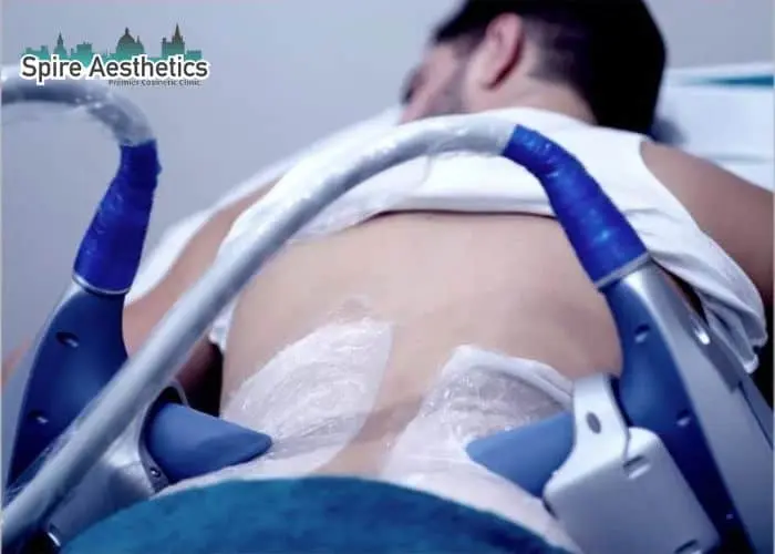 Man having fat freezing treatment done on love handles before a competitions Moseley to create a sculpted look.