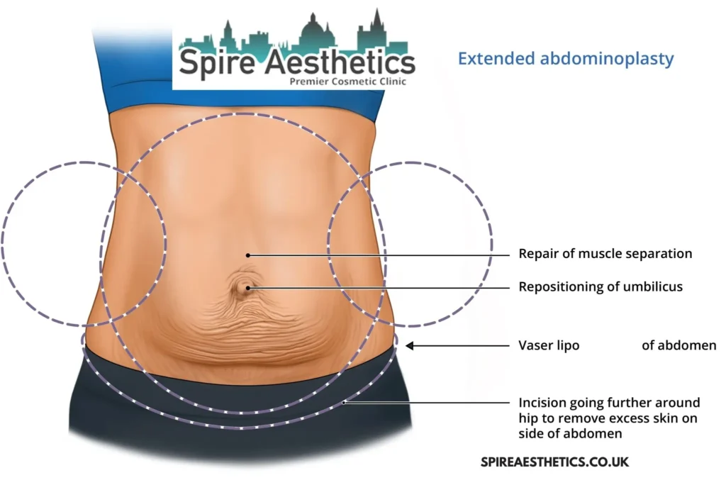Understanding Loose Skin After Gastric Band Moseley Surgery and HIFU Treatment