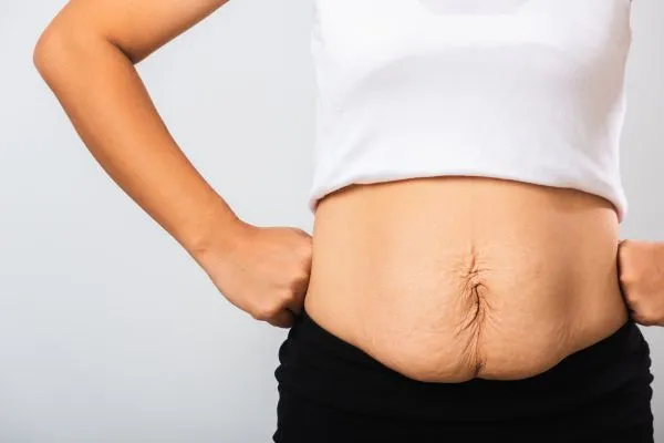 Image of a woman's stomach after weight loss with sagging skin following a gastric band Moseley