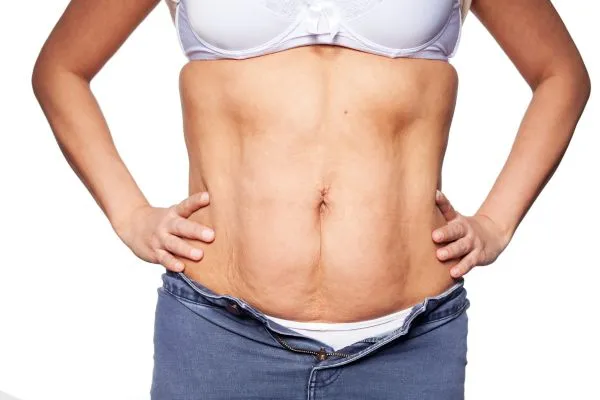 sagging skin on woman's stomach after weight loss injections Moseley