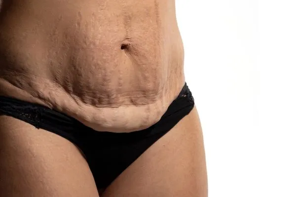 Image of womans stomach after weight loss injections Moseley showing saggy skin