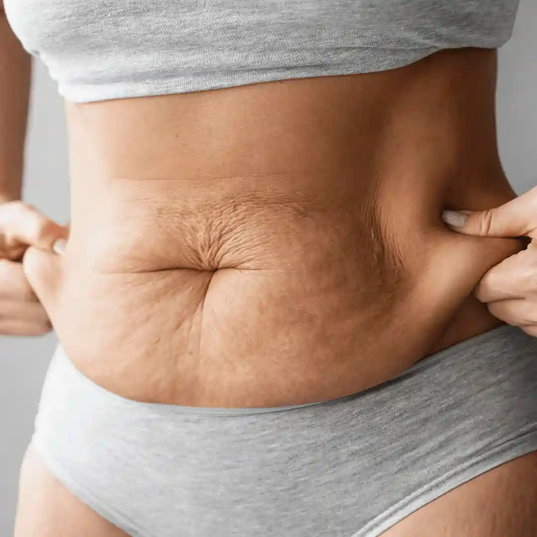 Is It Normal to Have Loose Skin After Pregnancy Moseley?
